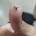 Espírito Santo registra mais de 12 mil casos de chikungunya