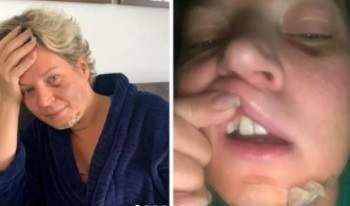 Deputada Joice Hasselmann aciona polícia após acordar com fraturas e hematomas