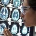 A nova droga que ‘interrompe’ evolução do Alzheimer